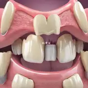 牙龈炎和牙周疾病有什么区别?
